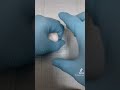 How doctors stop Nosebleeds
