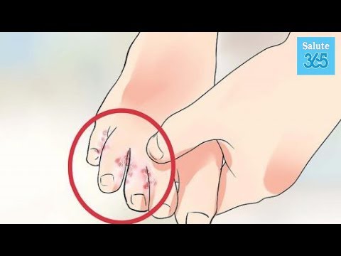 Il ginocchio caldo Massaggio con epicondilite del video gomito