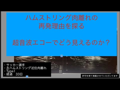 【エコー動態】ハムストリング近位肉離れ　経過33日