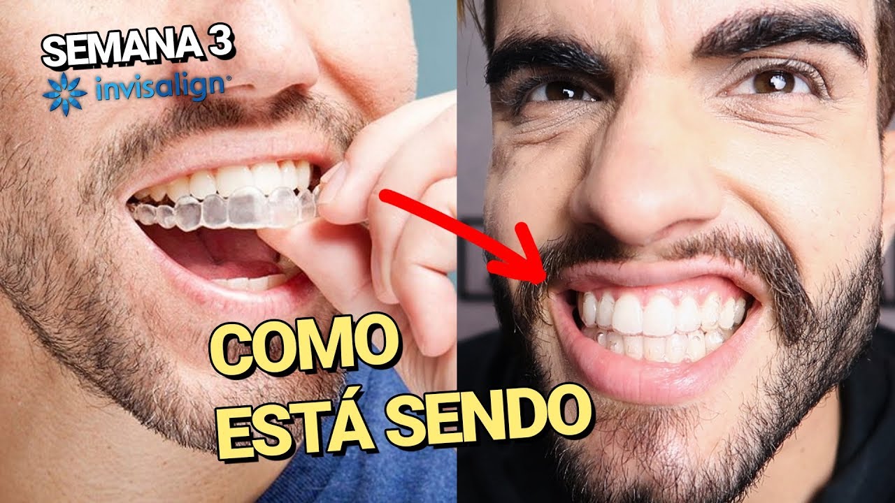 Como está sendo usar o INVISALIGN - Fácil de perder, dicção e trocas