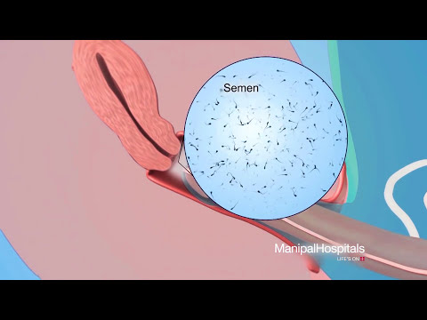 How to use Condoms for Men? | How to wear a Condom? - Manipal Hospitals