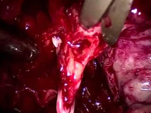Ha massaggio prostatico è necessaria nel trattamento della prostatite Il video massaggio prostatico