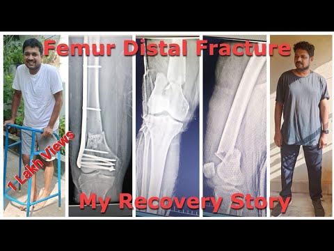 Distal Femur Fracture