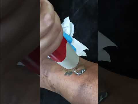 Laser Tattoo Removal in Klang Valley | Real Patient Results