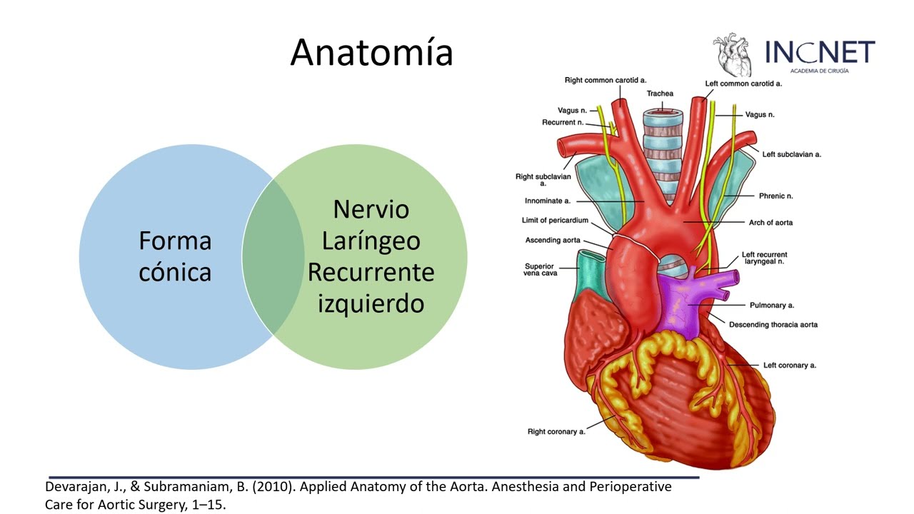 Conducto arterioso persistente