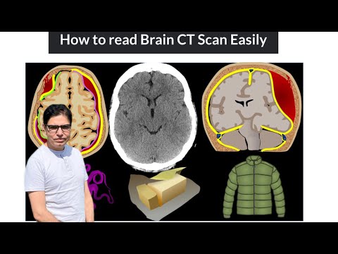 How to read CT Brain easily.