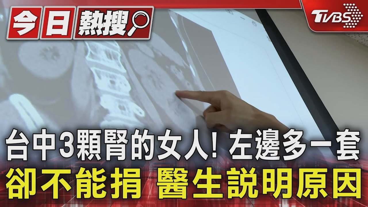 台中3顆腎的女人！左邊多一套卻不能捐　醫生說明原因