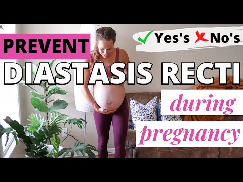 PREVENT DIASTASIS RECTI DURING PREGNANCY