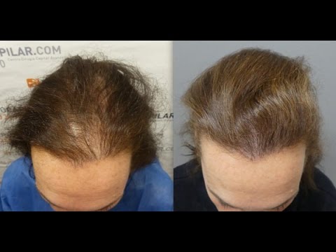 1101 Grafts. Hair Transplant by FUE Technique. HT Female alopecia. Injertocapilar.com. 1574/2015