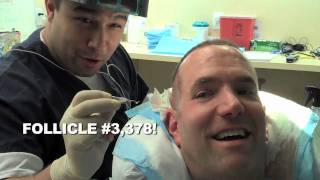 HAIR TRANSPLANT FUN!?