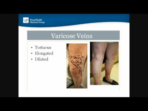 You 101: Understanding Varicose Veins