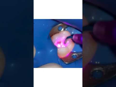 Désinfection laser sur une 16 partie 2 – Endodontie