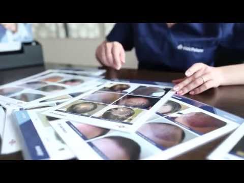 Greffe de cheveux - ÉCONOMISEZ 50%!