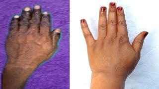 STRONG TREATMENT REMOVE WRINKLES ON HANDS AND FINGERS NATURALLY HAVE A YOUTHFUL HANDS
