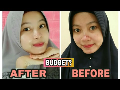 download lagu mp3 mp4 Harga Chemical Peeling Natasha, download lagu Harga Chemical Peeling Natasha gratis, unduh video klip Harga Chemical Peeling Natasha