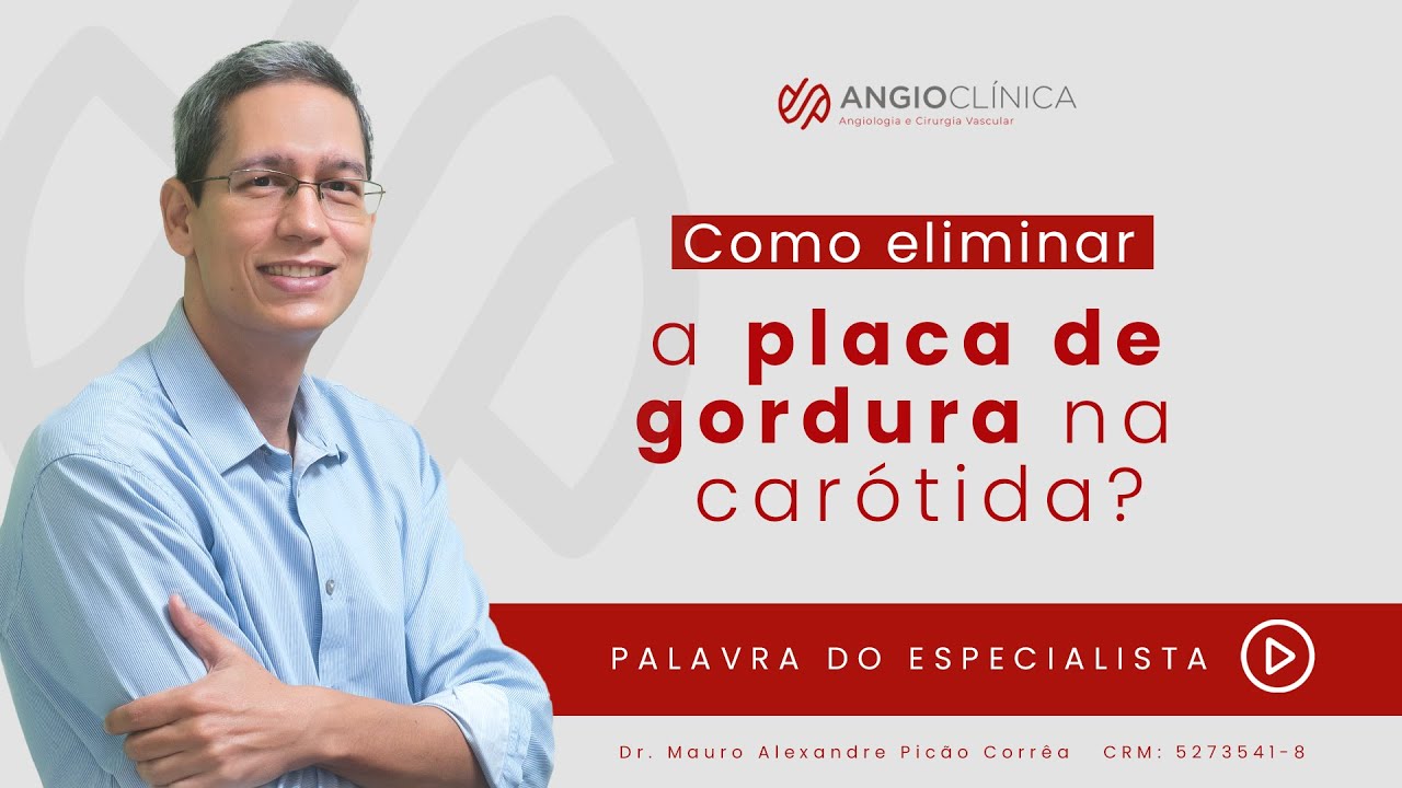 Como eliminar a placa de gordura na carótida?