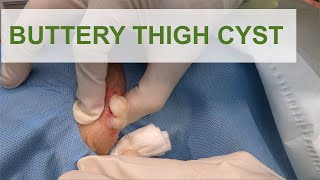 Buttery Thigh Cyst | Dr. Derm