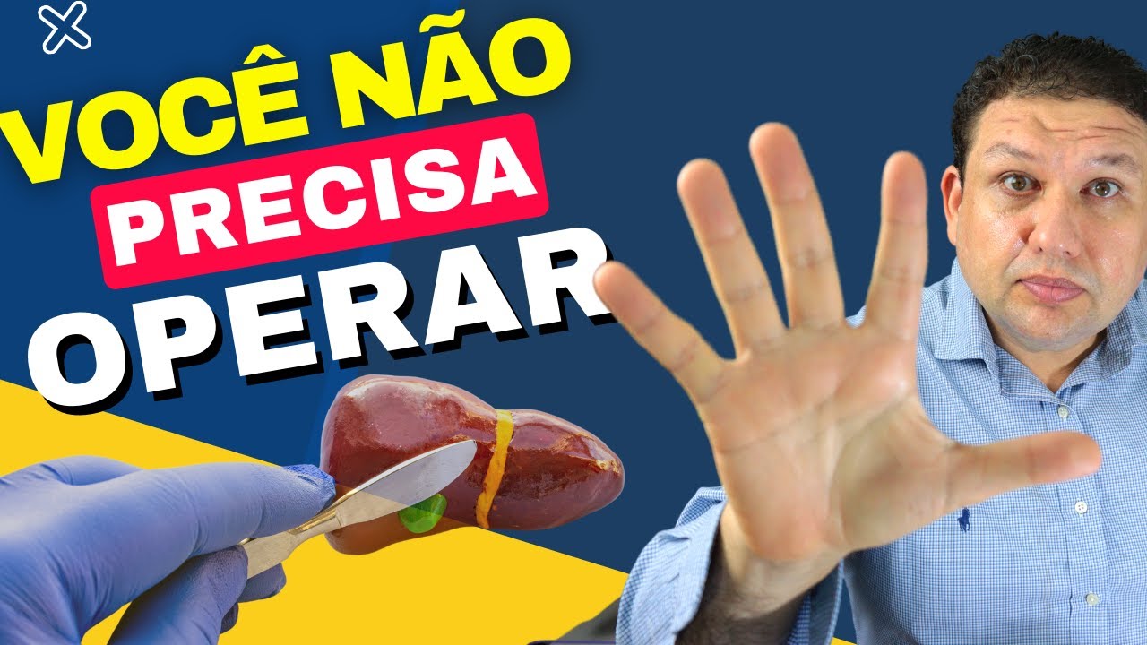 TODA PEDRA NA VESÍCULA PRECISA OPERAR? Saiba que pedras na vesícula não precisam operar.