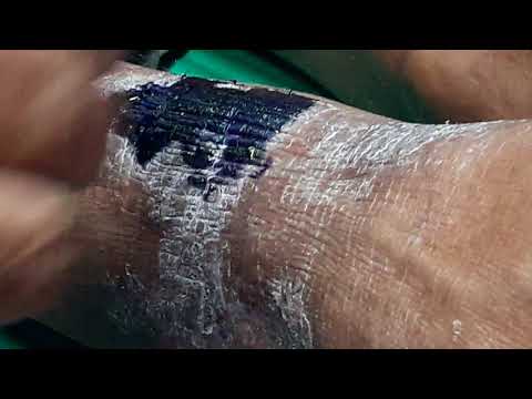 Che fare a psoriasi di palme Dermatite di atopic ad asma