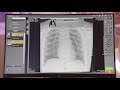 Digital image processing for medical applications solution manual
