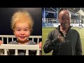 Uncombable Hair Syndrome and Other Rare Genetic Conditions