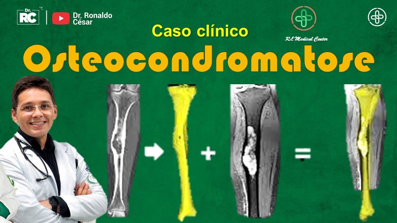 Osteocondromatose Múltipla Hereditária, exostoses ósseas, osteocondromas
