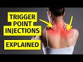 Myofascial Pain Trigger Point Injections Explained