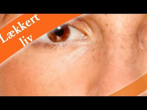 7 symptomer på polycystisk ovariesyndrom du ikke bør ignorere