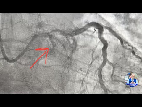 A complex Complicated CTO LCX! IVL lithotripsy and PCI . Step by step !