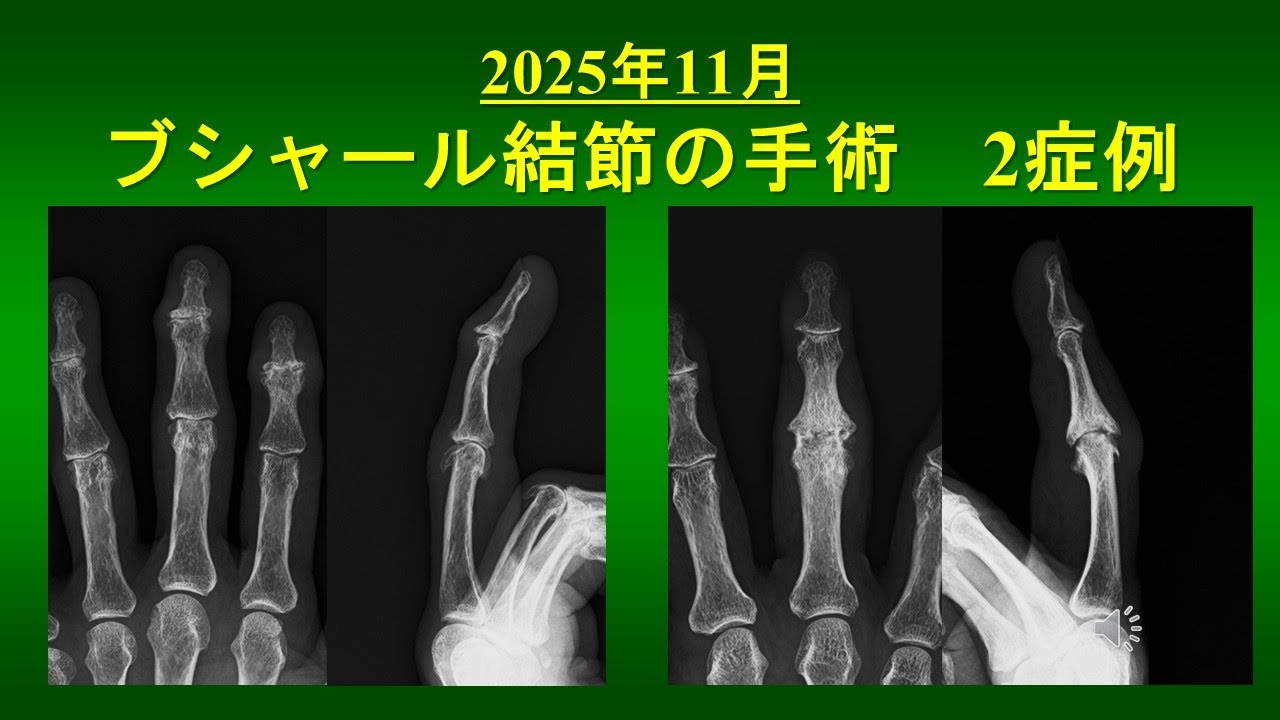 手指ブシャール結節の手術2症例　（2025年11月施行）屈筋腱切除・人工関節