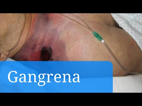 Ejemplo de menú para diabéticos Bajo nivel de azúcar en la sangre de los hombres después de 50 años