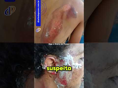 Motociclista fica ferido após acidente na GO-110
