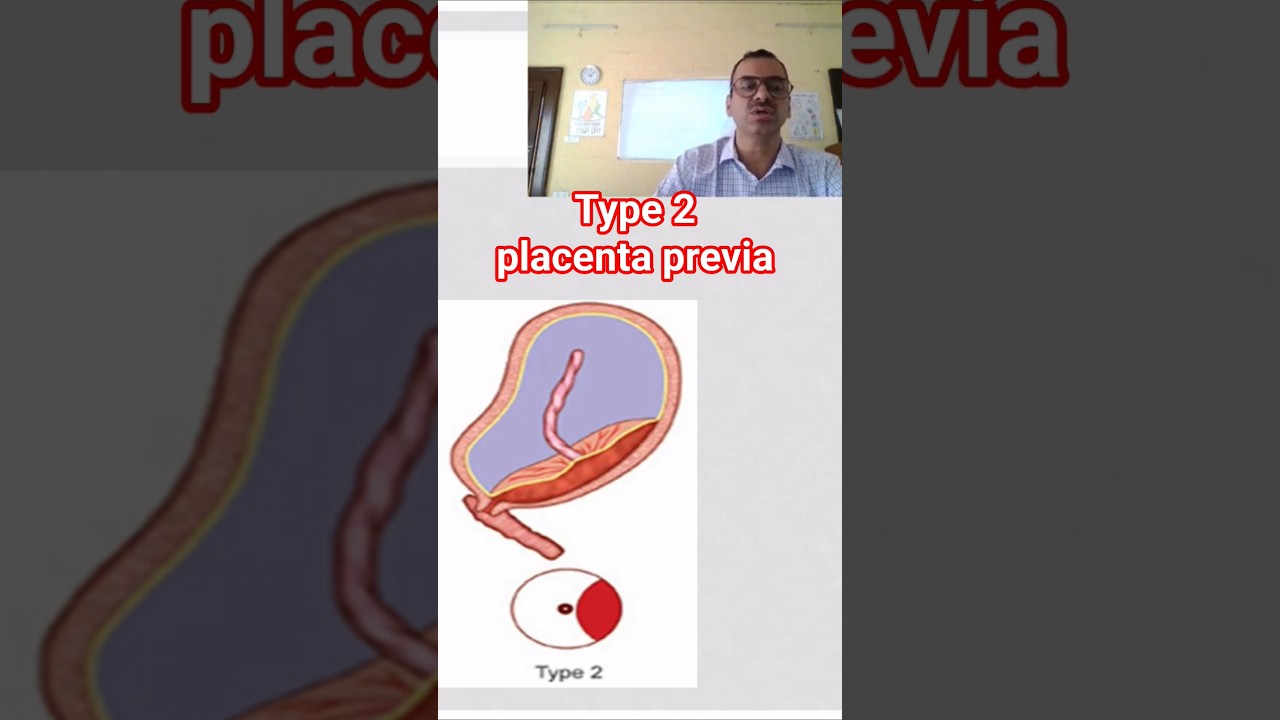 type 2 placenta previa