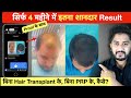 Hair Regrowth Result In 4 Months बिना Hair Transplant के