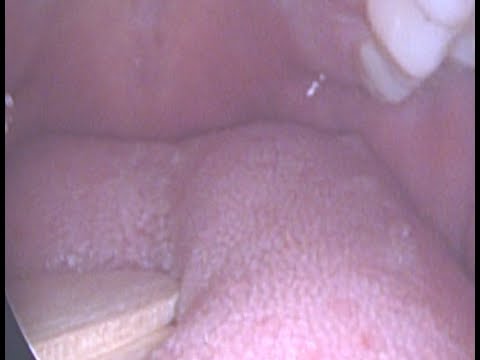 Learning About The Tonsils