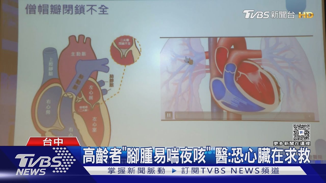 高齡長者腳水腫易喘恐非僅老化警訊 醫:心臟在求救快就醫