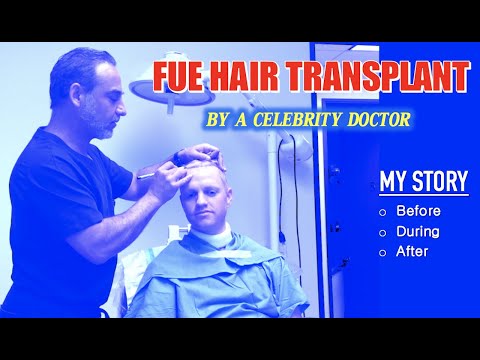 Celebrity Doctor Hair Transplant Surgery FUE MY STORY (Before, During, After)