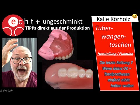 Verbesserter Halt von Totalprothesen - Abformung, Funktion und Unterstützung von Tuberwangentaschen