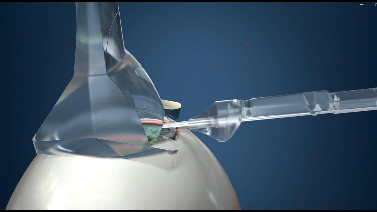 iStent Infinite Animation