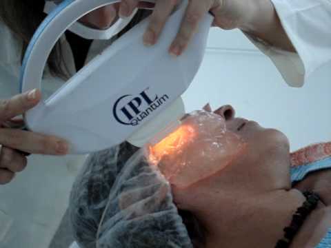 LIP®  Luz Intensa Pulsada (StarLux e Harmony) Dra. Giseli Petrone