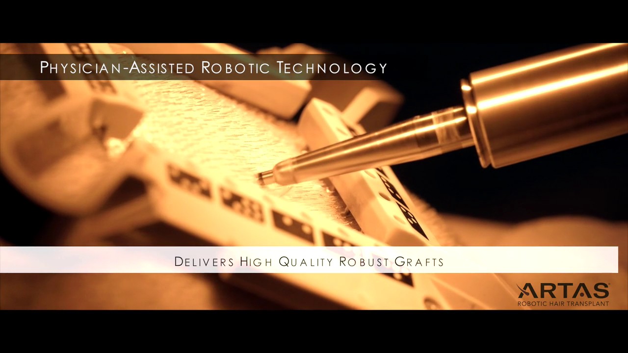 ARTAS Hair Studio - ARTAS Robotic Hair Transplant Procedure Video - Columbus Ohio Hair Restoration