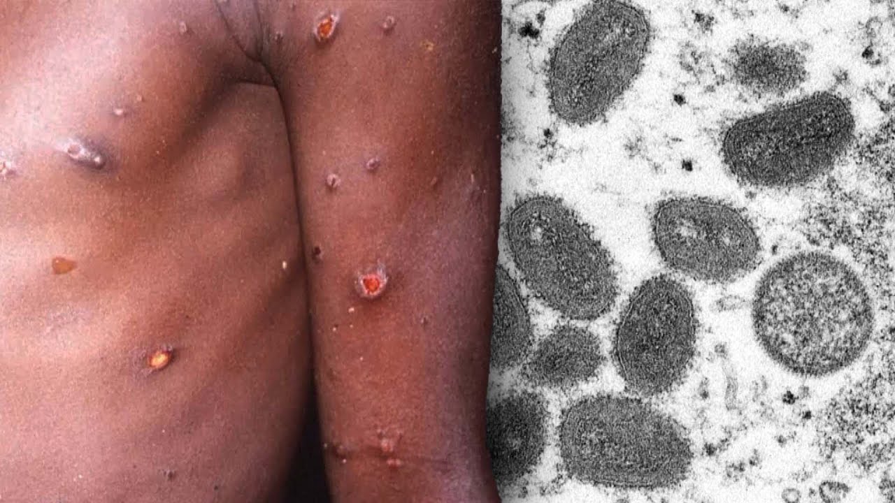 Rare Monkeypox Virus Found in Several Countries
