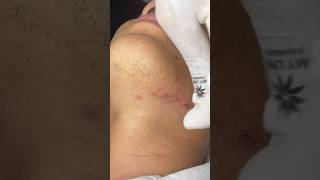 New inflamed pimple #skincare #satisfying #acne #shortvideo