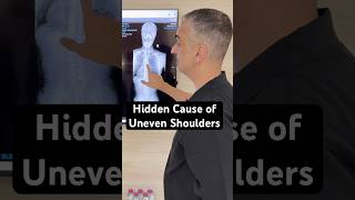 One Shoulder Higher Than The Other? Hidden Cause Found #shorts
