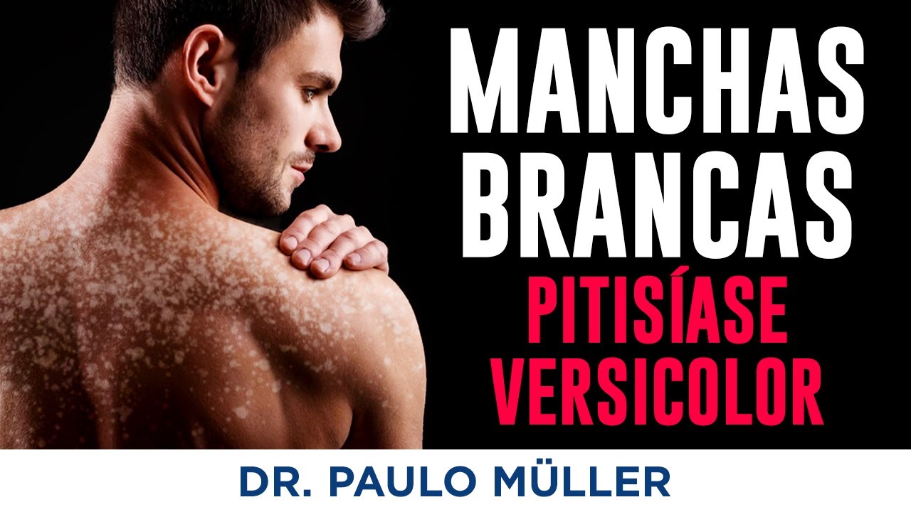 Manchas Brancas na Pele: Pitiríase Versicolor (Pano Branco) – Dr. Paulo Müller Dermatologista.