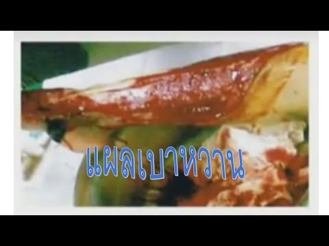 สิ่งที่ปฏิบัติหน้าที่เป็นโรคสะเก็ดเงิน ว่านหางจระเข้ยาสำหรับโรคสะเก็ดเงิน