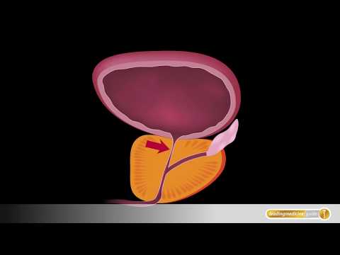 Sekretion Stagnation in der Prostatadrüse Salz auf der Prostata