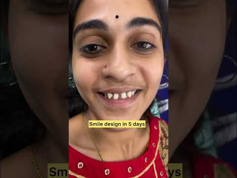 Smile design in 5 days,#smilemore #vijayadental#hyderabad #smiling #teeth#ytshorts