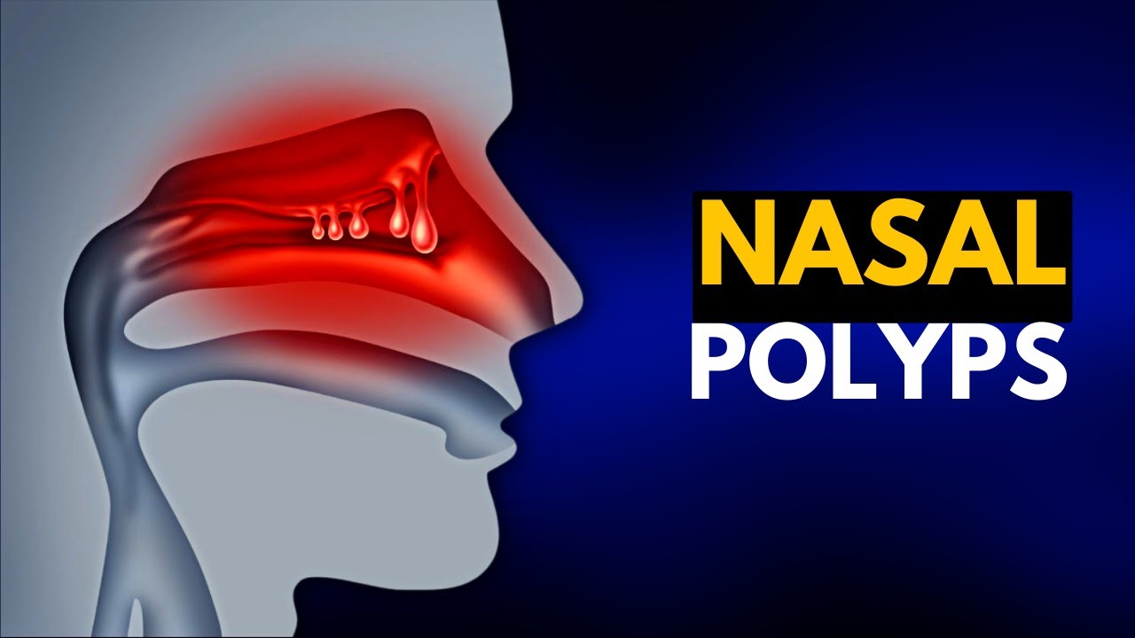 NASAL POLYPS, Causes, SIgns and Symptoms, Diagnosis and Treatment. - YouTube