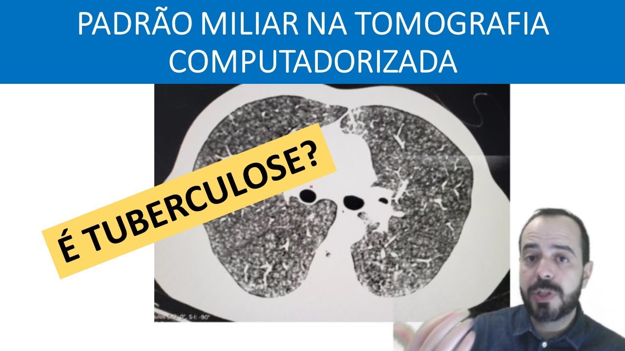 TUBERCULOSE NO IMUNODEPRIMIDO. PADRÃO MILIAR NA TOMOGRAFIA. Outros diagnósticos diferenciais.